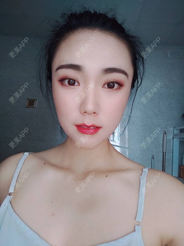 更美 - 更美魔女的埋线提升经验 | 埋线提升 | 郑州