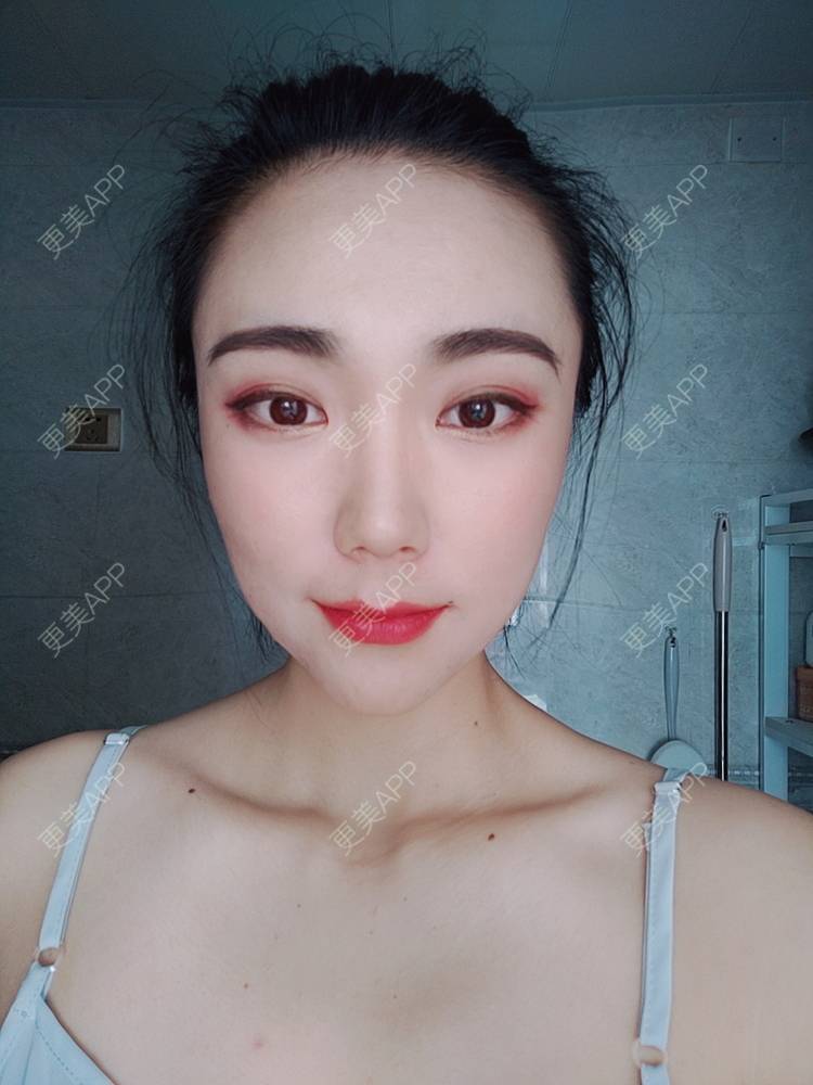 更美 - 更美魔女的埋线提升经验 | 埋线提升 | 郑州