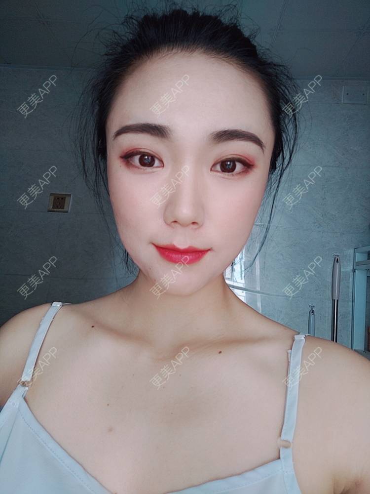 更美 - 更美魔女的埋线提升经验 | 埋线提升 | 郑州