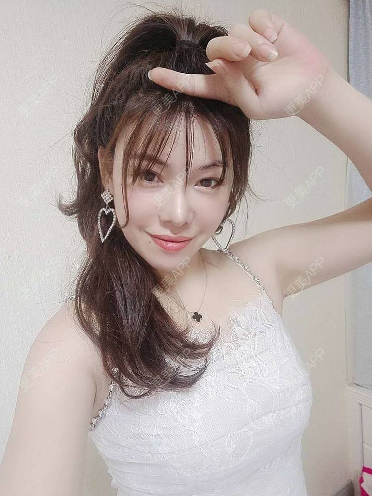 更美 - 琵琶弦的自体脂肪填充泪沟经验 | 自体脂肪丰面颊 | 自体脂肪丰唇 | 自体脂肪丰苹果肌 | 自体脂肪填充泪沟 | 自体脂肪隆鼻 | 自体脂肪垫下巴 | 自体脂肪丰太阳穴 | 自体脂肪丰额头 | 自体脂肪全面部填充 | 自体脂肪面部填充