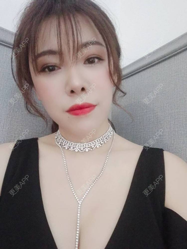 更美 - 琵琶弦的自体脂肪填充泪沟经验 | 自体脂肪丰面颊 | 自体脂肪丰唇 | 自体脂肪丰苹果肌 | 自体脂肪填充泪沟 | 自体脂肪隆鼻 | 自体脂肪垫下巴 | 自体脂肪丰太阳穴 | 自体脂肪丰额头 | 自体脂肪全面部填充 | 自体脂肪面部填充