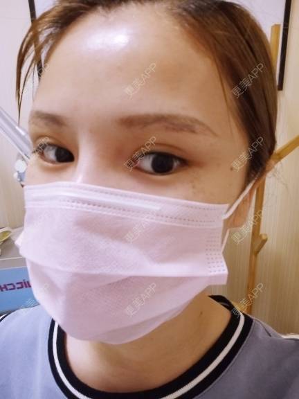 更美 - 路上有亻的激光洗眉经验 | 上海 | 激光洗眉