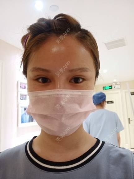 更美 - 路上有亻的激光洗眉经验 | 上海 | 激光洗眉