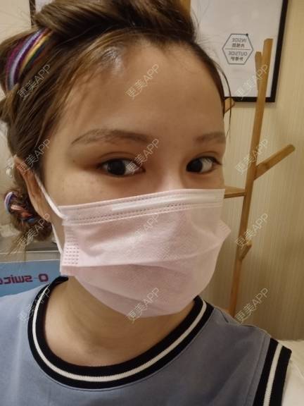 更美 - 路上有亻的激光洗眉经验 | 上海 | 激光洗眉