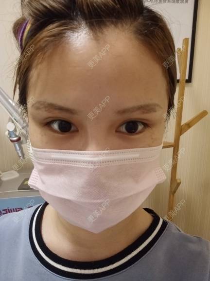 更美 - 路上有亻的激光洗眉经验 | 上海 | 激光洗眉