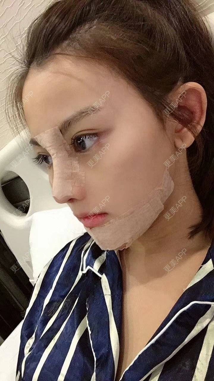 更美 - 果敢柠檬精的鼻部多项经验 | 耳软骨隆鼻 | 鼻部多项 | 鼻中隔软骨垫鼻头 | 鼻小柱延长 | 自体软骨垫鼻尖 | 中山