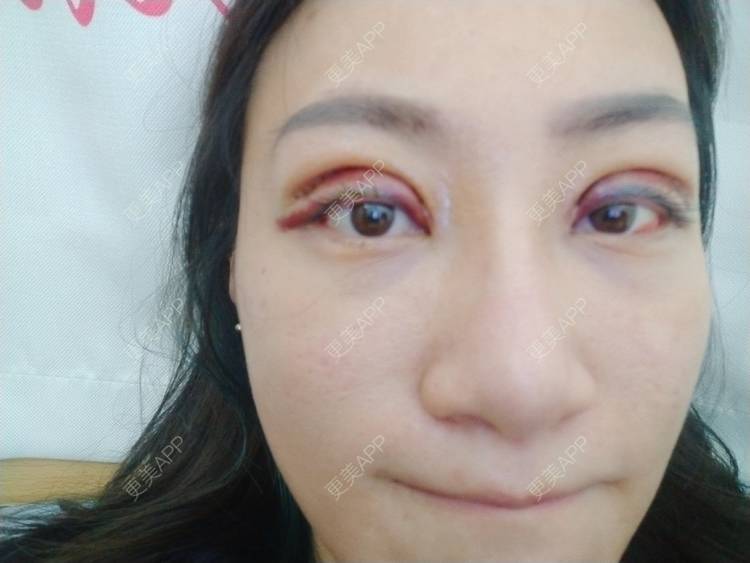 更美 - 逗逗是剩女的双眼皮经验 | 双眼皮 | 全切双眼皮 | 广州 | 埋线隆鼻 | 视频日记