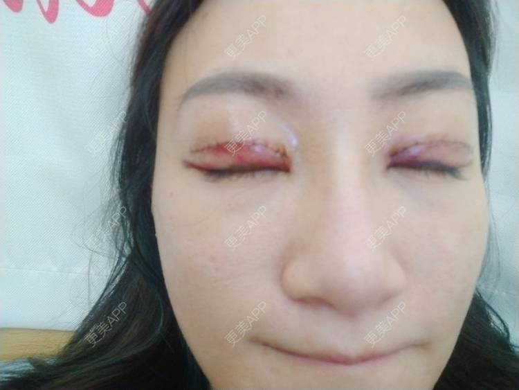 更美 - 逗逗是剩女的双眼皮经验 | 双眼皮 | 全切双眼皮 | 广州 | 埋线隆鼻 | 视频日记