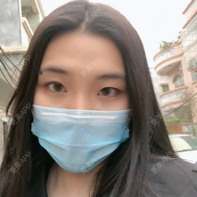 更美 - 是你紫霞仙女的双眼皮经验 | 双眼皮 | 中山 | 视频日记