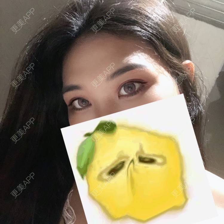 更美 - 是你紫霞仙女的双眼皮经验 | 双眼皮 | 中山 | 视频日记