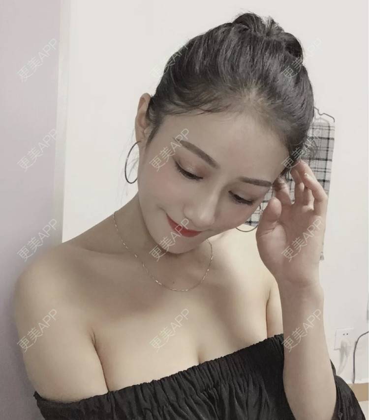 更美 - 樱花草🌸的自体脂肪隆胸经验 | 自体脂肪隆胸 | 南昌