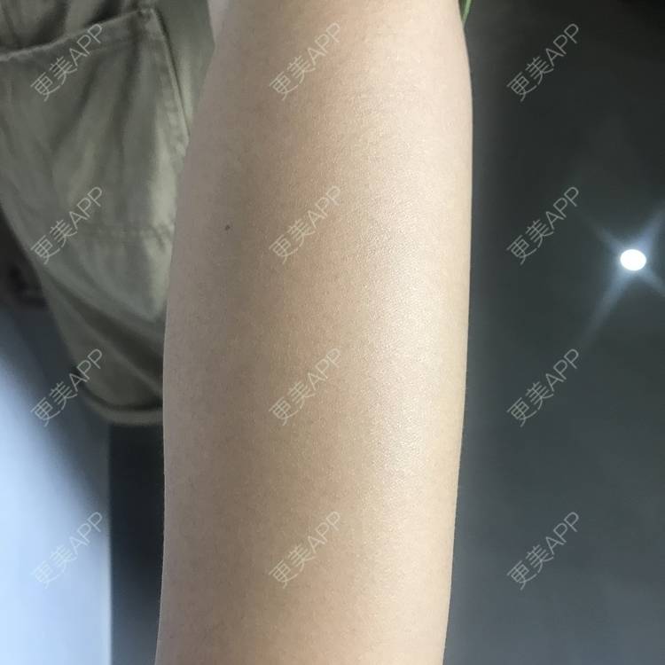 更美 - 更美用户5WUiAcMqlp的光子脱毛经验 | 光子脱毛 | 郑州