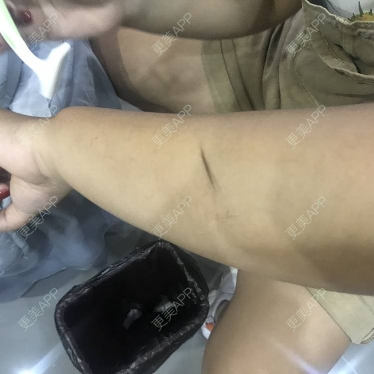 更美 - 更美用户5WUiAcMqlp的光子脱毛经验 | 光子脱毛 | 郑州