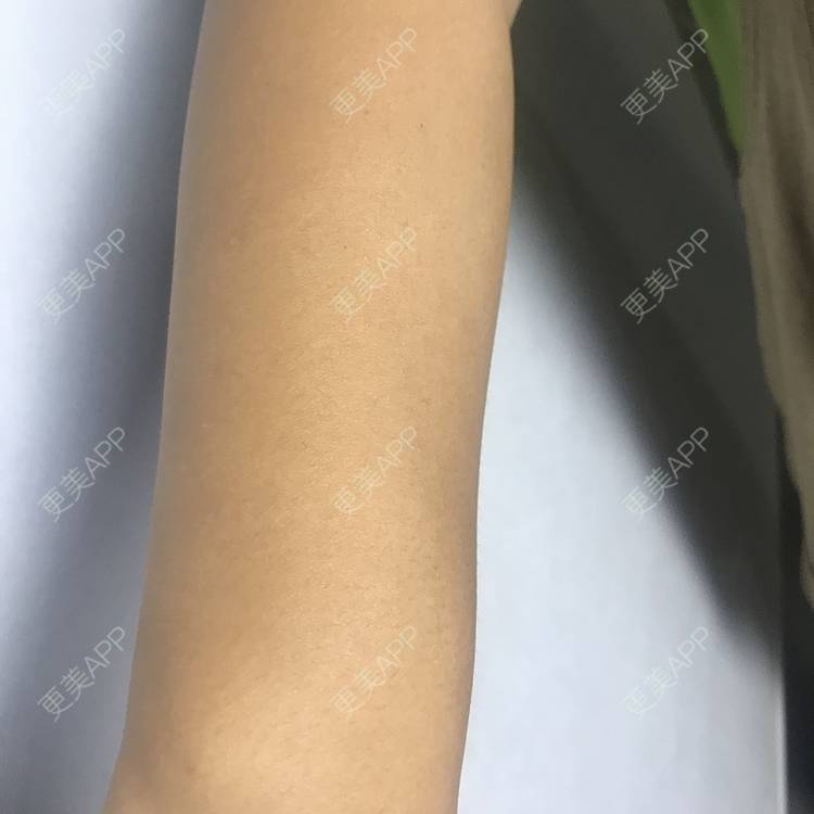 更美 - 更美用户5WUiAcMqlp的光子脱毛经验 | 光子脱毛 | 郑州
