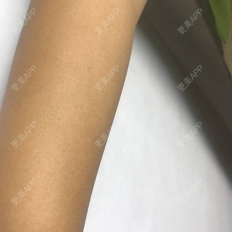 更美 - 更美用户5WUiAcMqlp的光子脱毛经验 | 光子脱毛 | 郑州