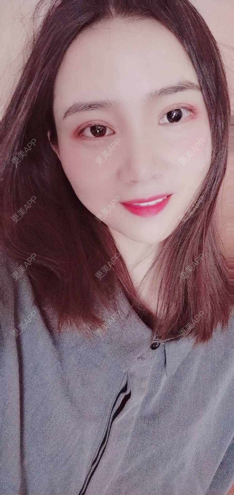 更美 - 更美用户222hTxLwTH的自体脂肪丰卧蚕经验 | 上海 | 自体脂肪丰卧蚕