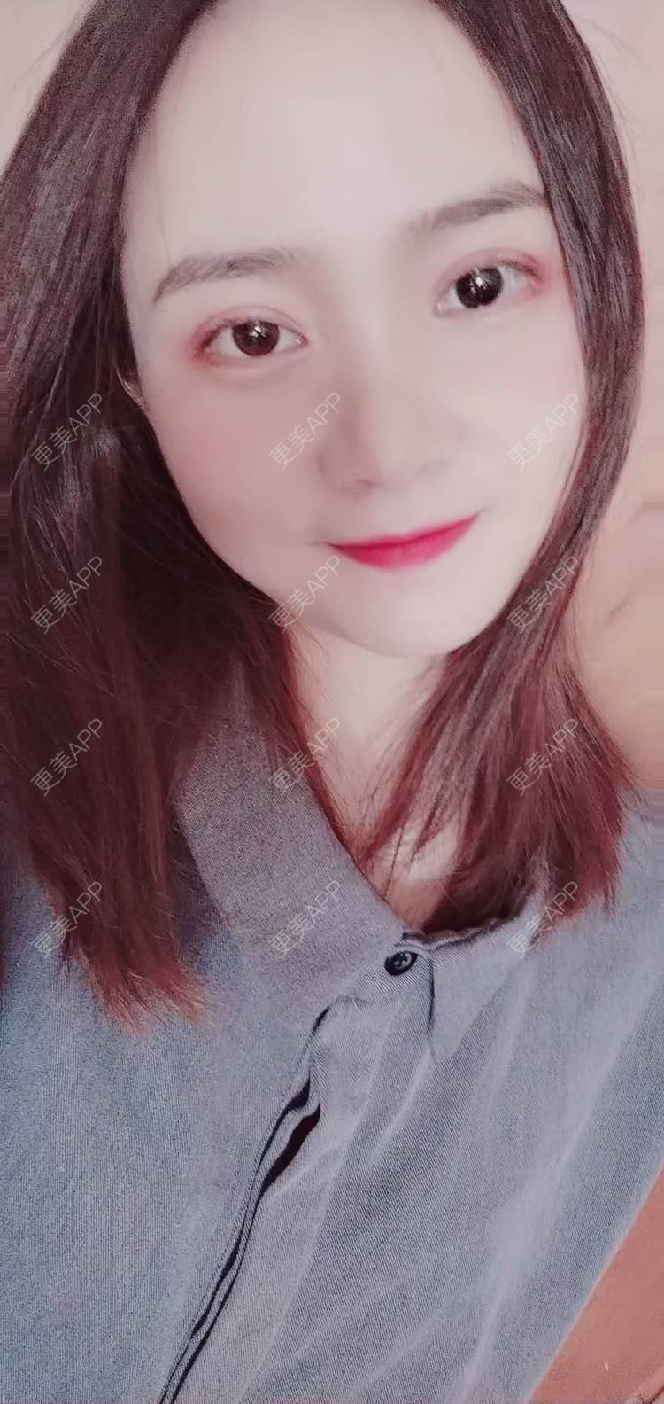 更美 - 更美用户222hTxLwTH的自体脂肪丰卧蚕经验 | 上海 | 自体脂肪丰卧蚕