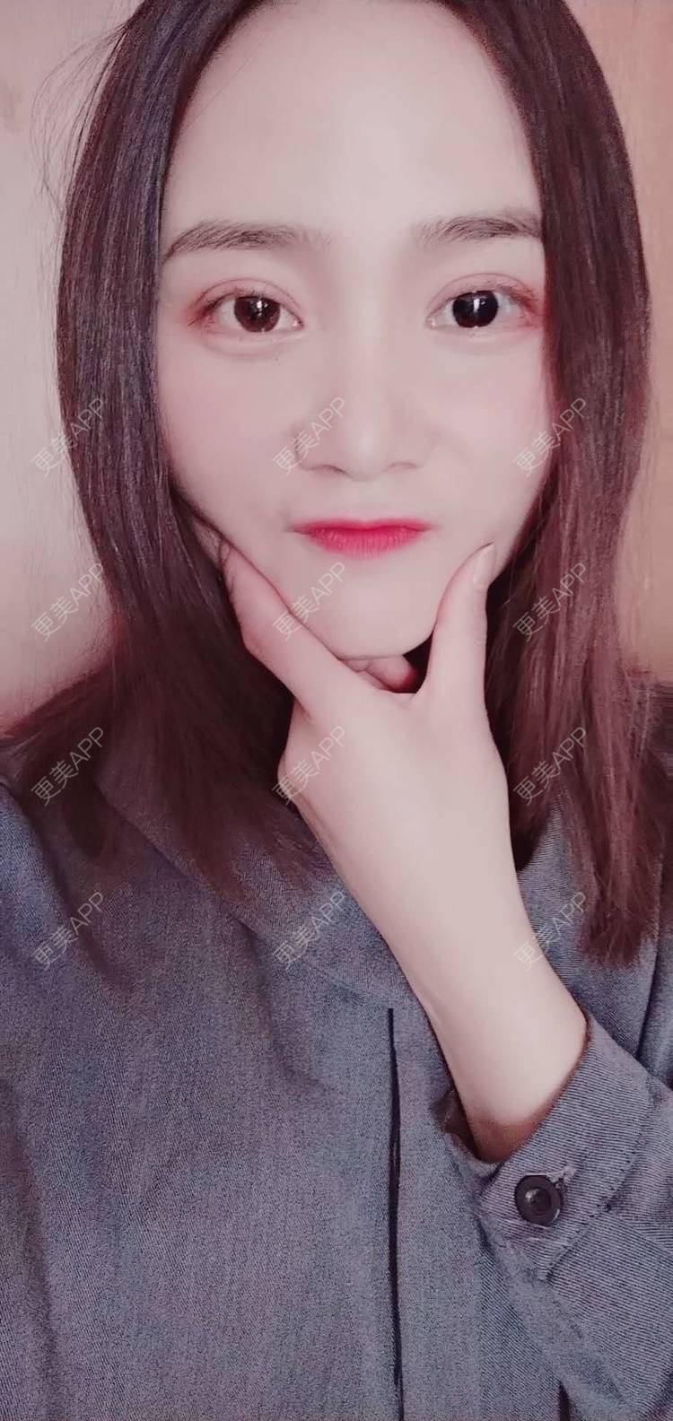 更美 - 更美用户222hTxLwTH的自体脂肪丰卧蚕经验 | 上海 | 自体脂肪丰卧蚕