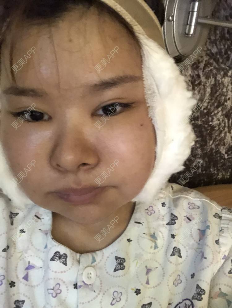更美 - 更美用户WOuVgkC9NU的颧骨内推经验 | 颧骨内推 | 成都 | 颧弓降低