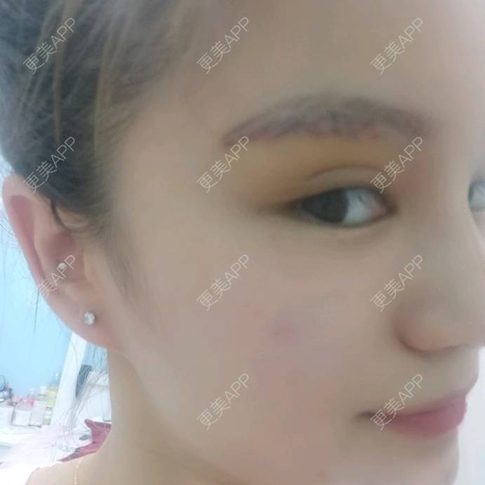 更美 - 路上有亻的激光洗眉经验 | 上海 | 激光洗眉