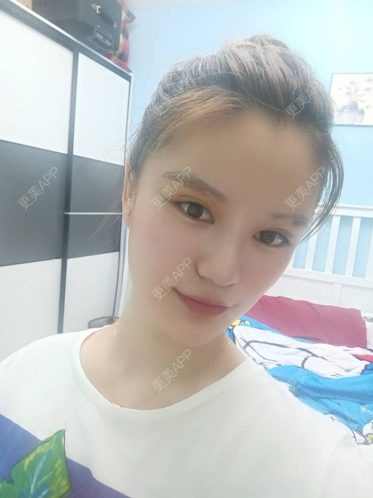 更美 - 路上有亻的激光洗眉经验 | 上海 | 激光洗眉
