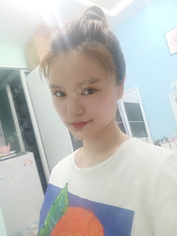 更美 - 路上有亻的激光洗眉经验 | 上海 | 激光洗眉