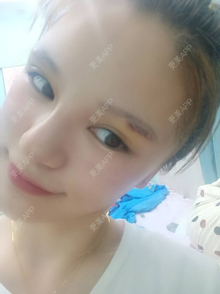更美 - 路上有亻的激光洗眉经验 | 上海 | 激光洗眉
