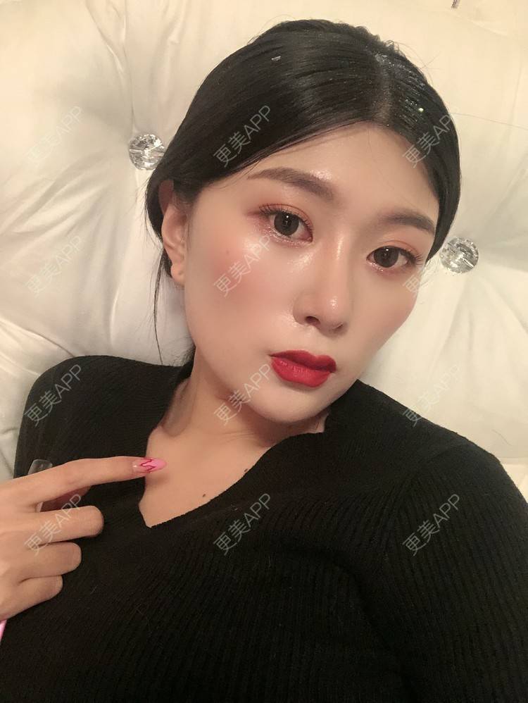 更美 - 更美用户d9XraeiAfE的鼻部多项经验 | 鼻部多项 | 清远