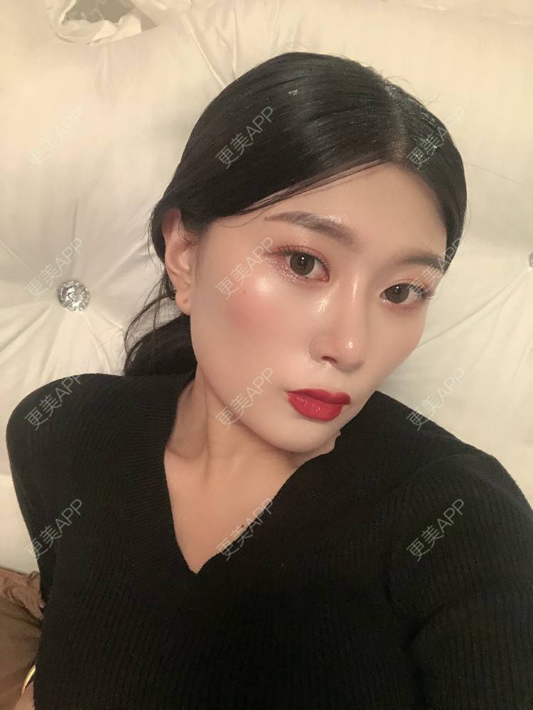 更美 - 更美用户d9XraeiAfE的鼻部多项经验 | 鼻部多项 | 清远