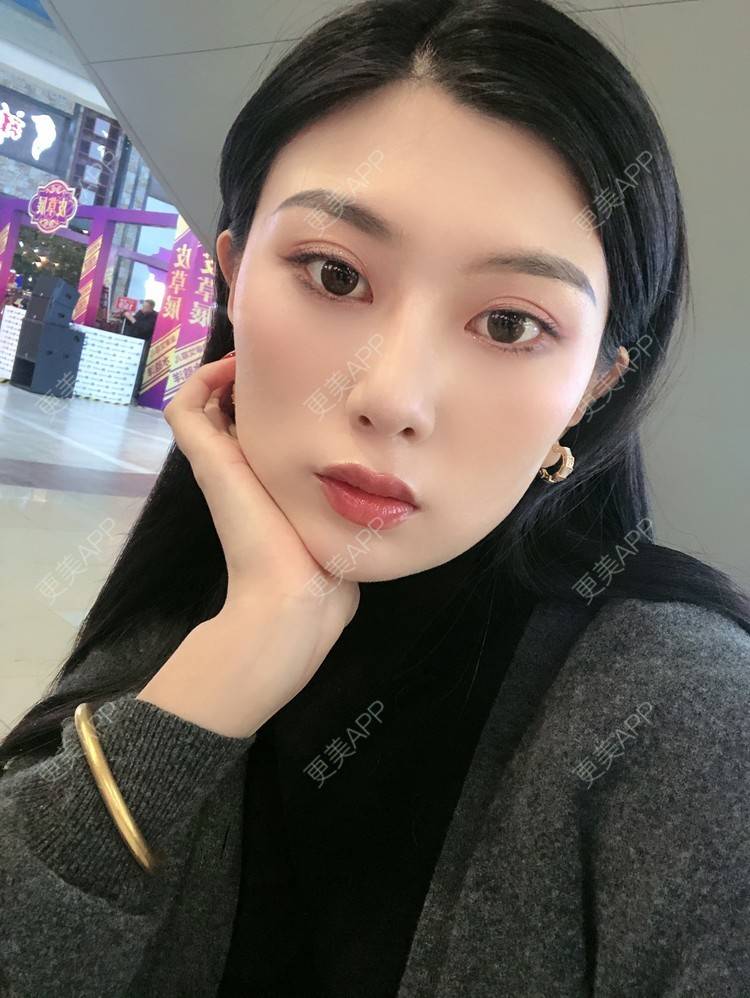 更美 - 更美用户d9XraeiAfE的鼻部多项经验 | 鼻部多项 | 清远