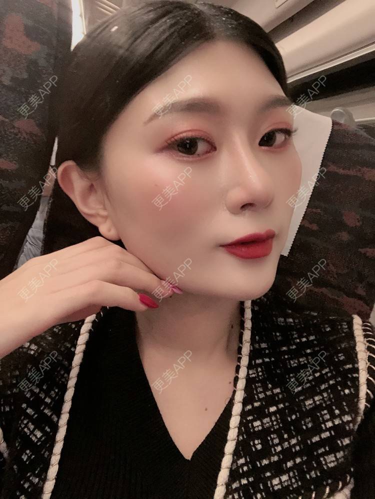 更美 - 更美用户d9XraeiAfE的鼻部多项经验 | 鼻部多项 | 清远