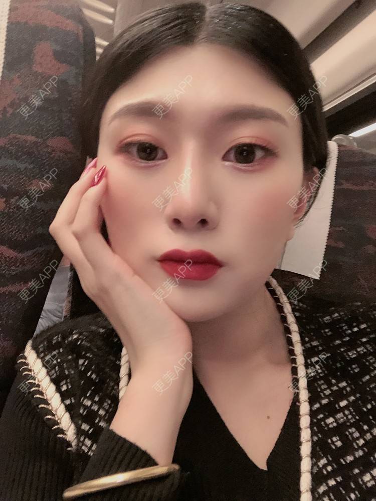 更美 - 更美用户d9XraeiAfE的鼻部多项经验 | 鼻部多项 | 清远