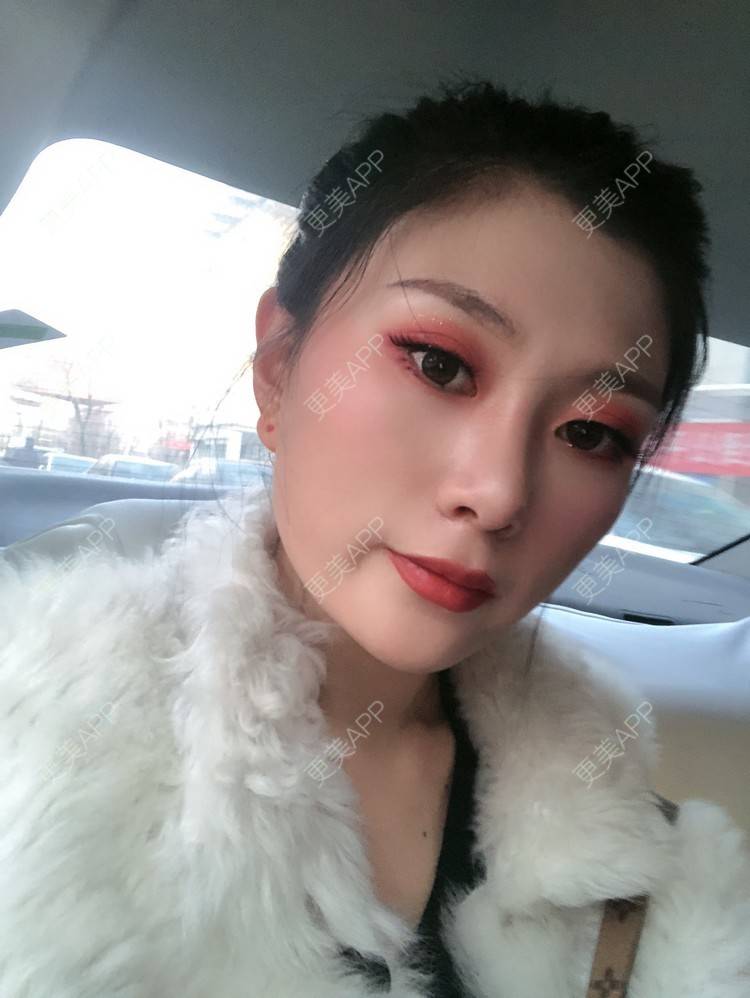 更美 - 更美用户d9XraeiAfE的鼻部多项经验 | 鼻部多项 | 清远