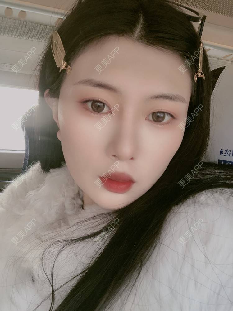 更美 - 更美用户d9XraeiAfE的鼻部多项经验 | 鼻部多项 | 清远