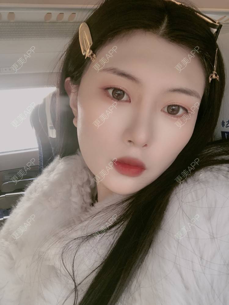 更美 - 更美用户d9XraeiAfE的鼻部多项经验 | 鼻部多项 | 清远