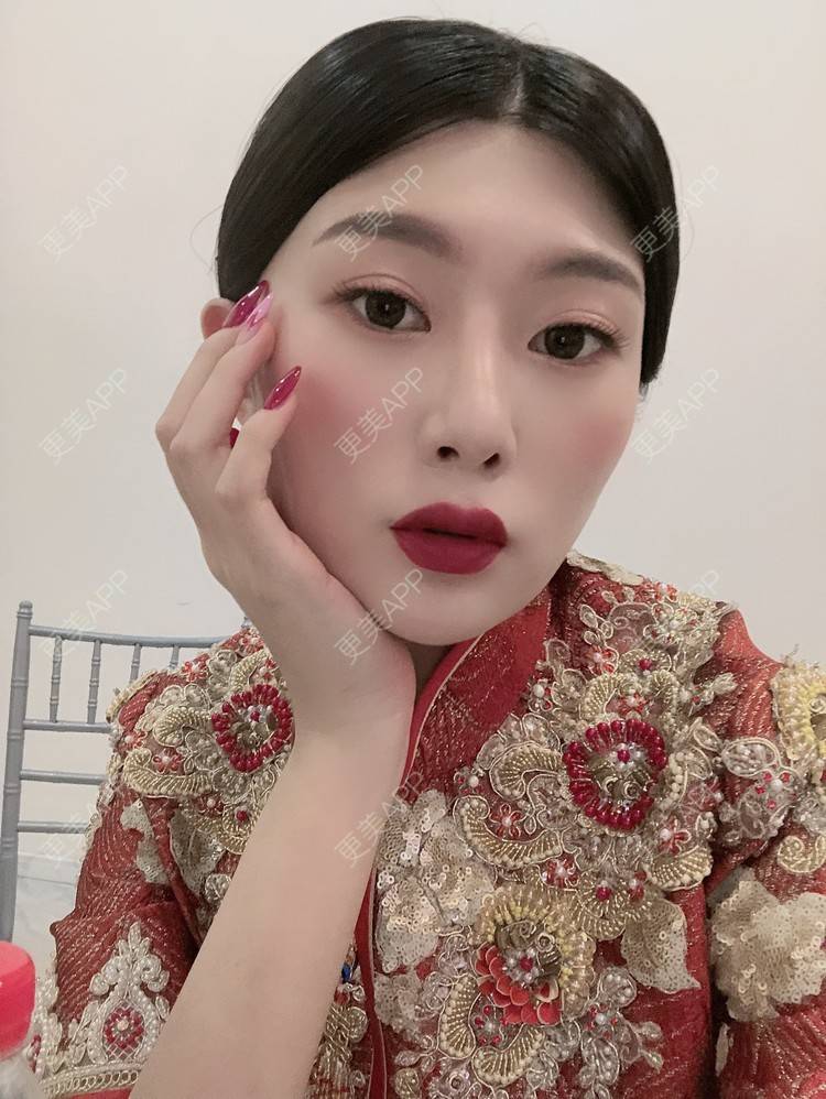 更美 - 更美用户d9XraeiAfE的鼻部多项经验 | 视频日记 | 鼻部多项 | 清远