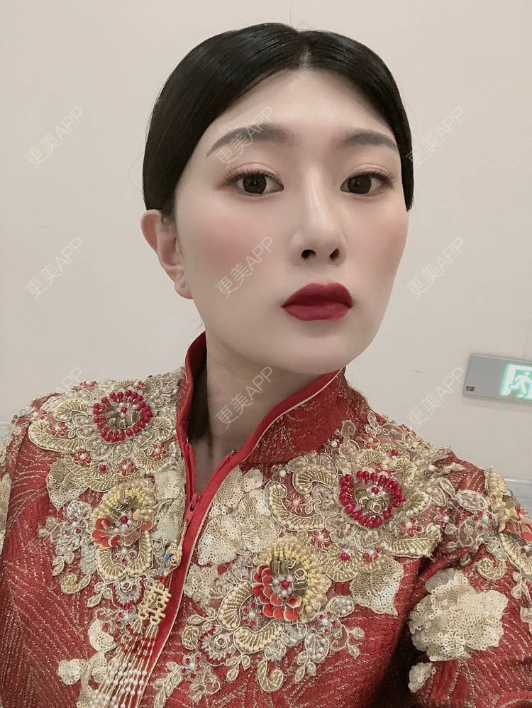 更美 - 更美用户d9XraeiAfE的鼻部多项经验 | 视频日记 | 鼻部多项 | 清远