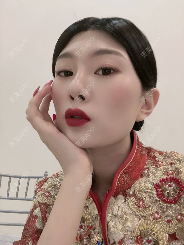 更美 - 更美用户d9XraeiAfE的鼻部多项经验 | 视频日记 | 鼻部多项 | 清远