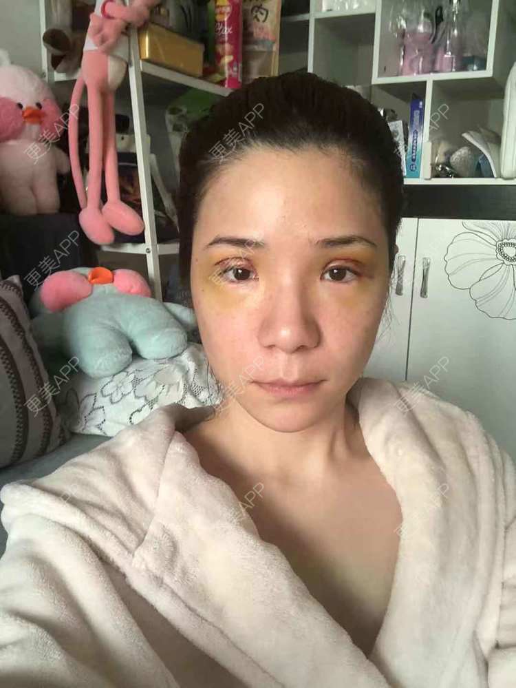 更美 - 更美好点的双眼皮经验 | 广州 | 双眼皮 | 双眼皮修复