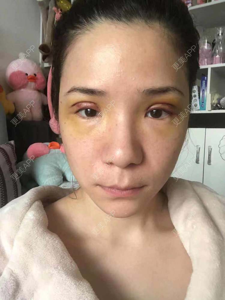 更美 - 更美好点的双眼皮经验 | 广州 | 双眼皮 | 双眼皮修复