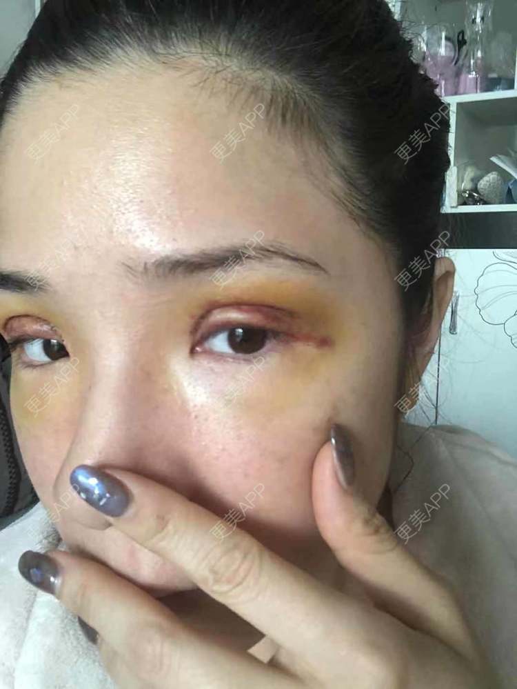更美 - 更美好点的双眼皮经验 | 广州 | 双眼皮 | 双眼皮修复