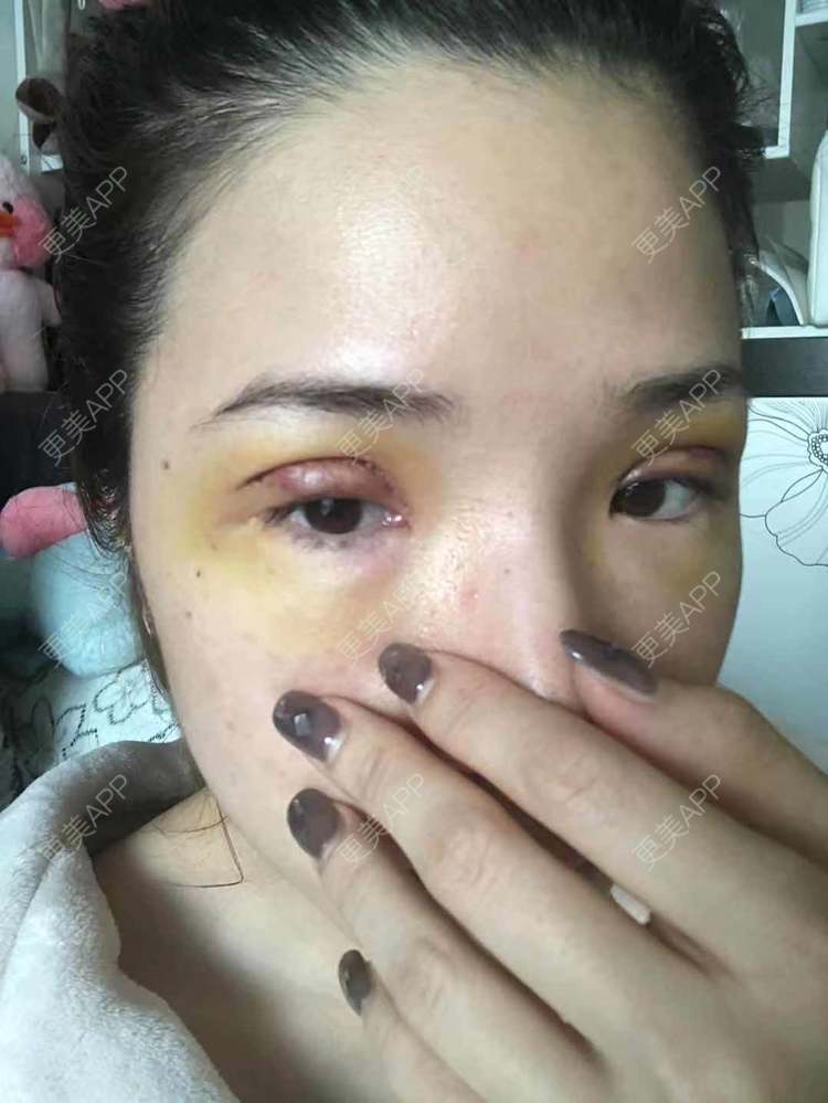 更美 - 更美好点的双眼皮经验 | 广州 | 双眼皮 | 双眼皮修复