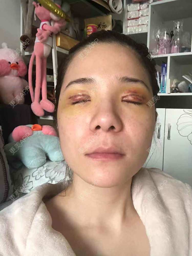 更美 - 更美好点的双眼皮经验 | 广州 | 双眼皮 | 双眼皮修复
