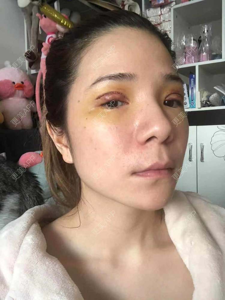 更美 - 更美好点的双眼皮经验 | 广州 | 双眼皮 | 双眼皮修复