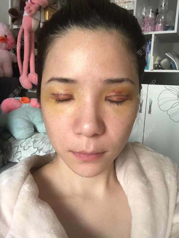 更美 - 更美好点的双眼皮经验 | 广州 | 双眼皮 | 双眼皮修复