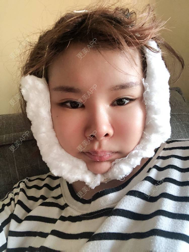 更美 - 更美用户WOuVgkC9NU的颧骨内推经验 | 颧骨内推 | 成都 | 颧弓降低