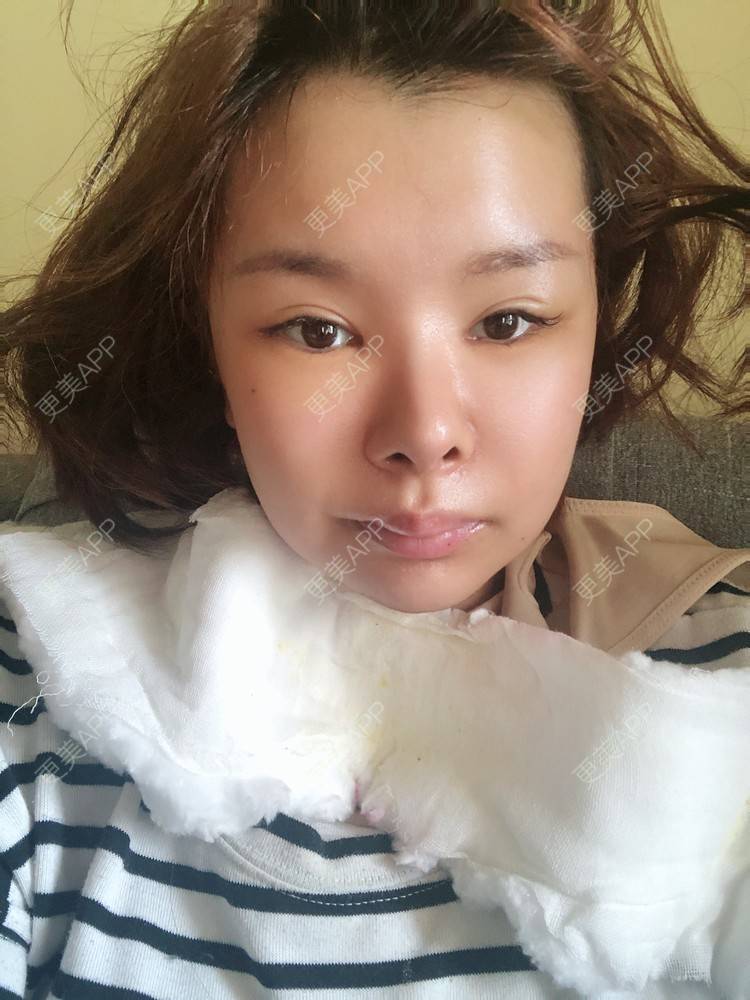 更美 - 更美用户WOuVgkC9NU的颧骨内推经验 | 颧骨内推 | 成都 | 颧弓降低