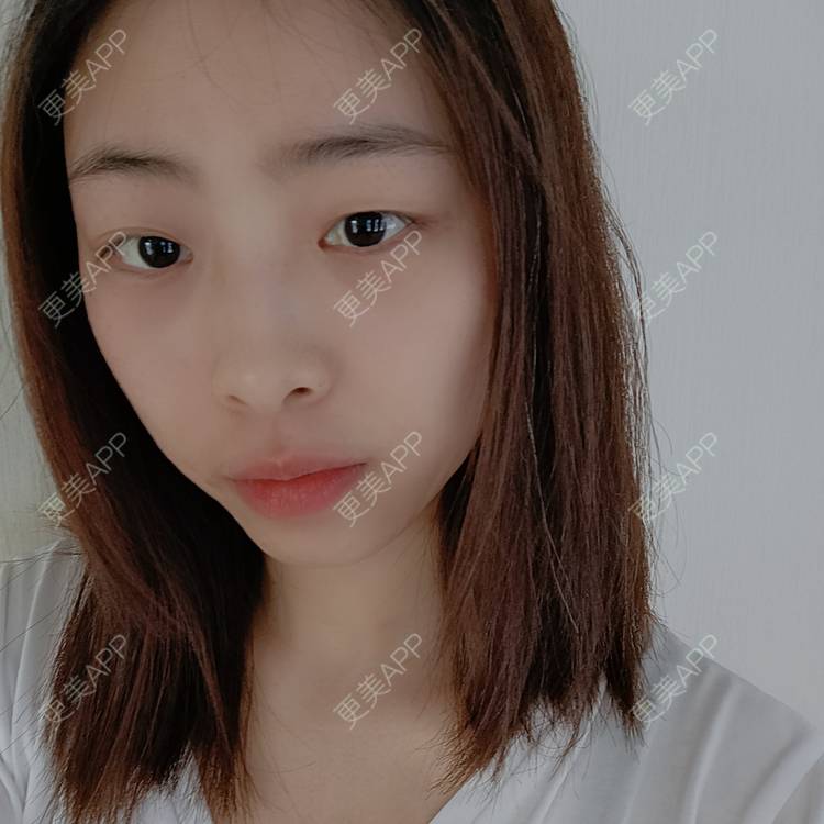 更美 - 蔓蔓青萝-的双眼皮经验 | 双眼皮 | 开内眼角 | 内切去眼袋 | 重庆
