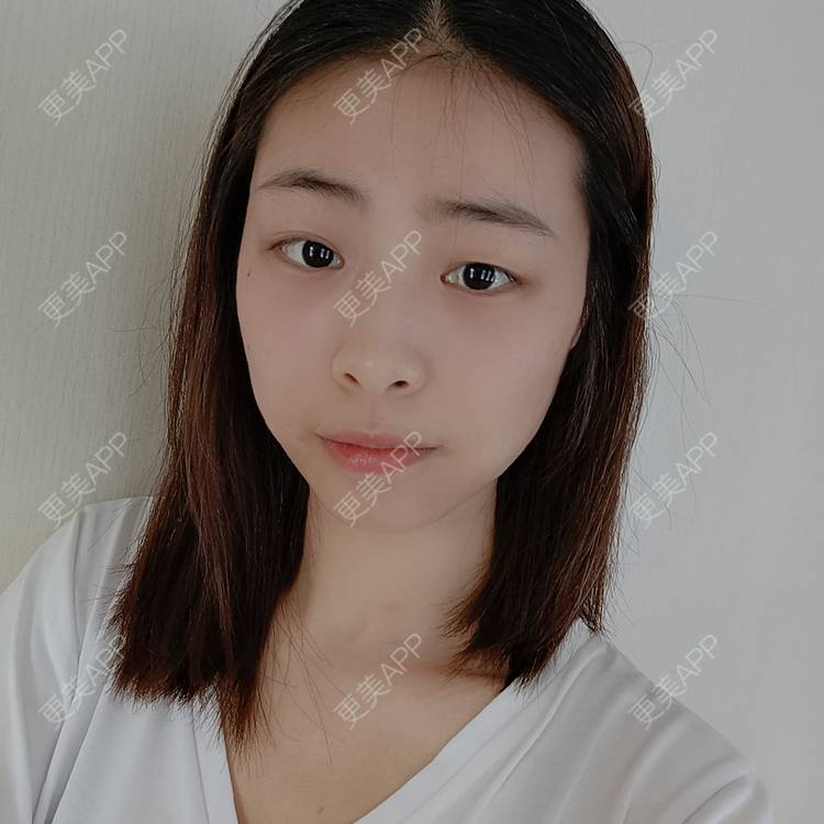 更美 - 蔓蔓青萝-的双眼皮经验 | 双眼皮 | 开内眼角 | 内切去眼袋 | 重庆