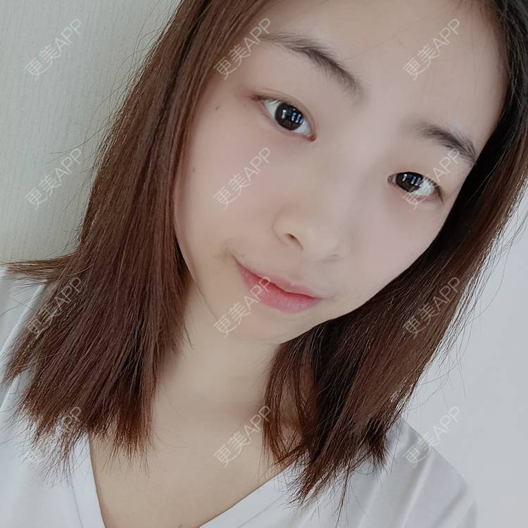 更美 - 蔓蔓青萝-的双眼皮经验 | 双眼皮 | 开内眼角 | 内切去眼袋 | 重庆